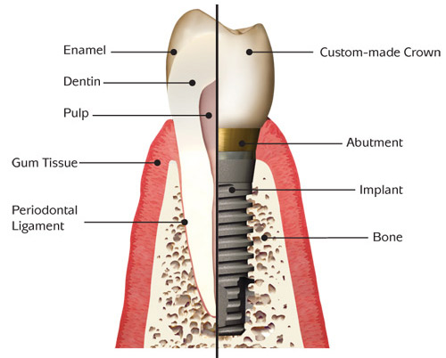The image shows a detailed diagram of a human tooth, labeled with various parts such as enamel, dentin, pulp, abutment, implant, periodontal ligament, bone, and a crown. It also includes annotations for custom-made crown and a custom-made crown made from bone tissue.