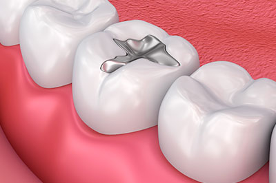 The image shows a close-up view of a dental implant inserted into a human tooth socket with surrounding teeth and gums.
