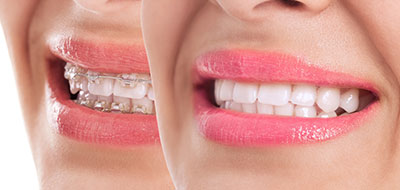 The image features a woman with a radiant smile showcasing her teeth, and there s an overlaid effect that creates a mirrored reflection of her face.