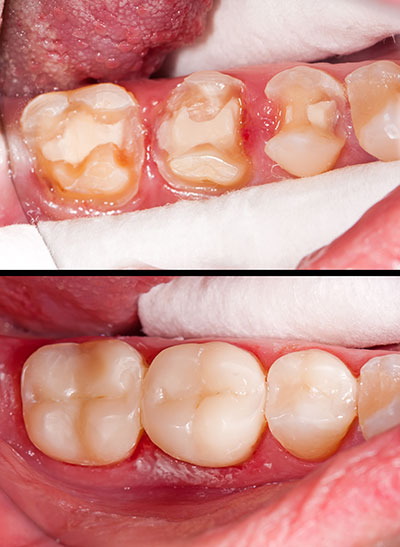 The image displays a close-up view of a person s mouth with teeth showing signs of decay and gum disease, emphasizing dental health issues.
