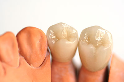 The image displays two sets of teeth side by side, with one set appearing to be natural human teeth and the other set resembling artificial or prosthetic teeth, possibly made from a material that mimics the appearance of bone or gum tissue.