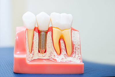 The image shows a dental implant model with artificial teeth, set against a pink background, possibly for educational or promotional purposes.