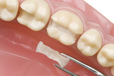 The image shows a close-up view of a dental implant being placed into a prepared tooth socket within an open mouth model, with a metal tool holding the implant in place and a small piece of white material possibly related to the implant process.