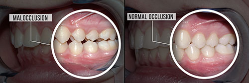 The image displays two photographs of a person s mouth with teeth showing, before and after dental treatment, focusing on the differences in tooth alignment and coloration, with one side showing natural teeth and the other showing modified teeth.