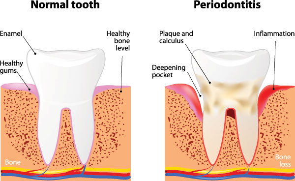The image shows a three-panel diagram illustrating the normal tooth structure on the left, a tooth with periodontitis in the middle with annotations indicating the progression of gum disease, and a cross-sectional view of a tooth with periodontitis on the right highlighting bone loss around the teeth.