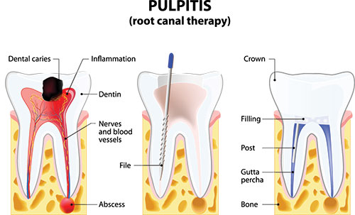 The image shows a diagrammatic representation of a pulpitis with annotations explaining different parts of the tooth s structure, including the root canal, dental caries, inflammation, crown, filling, nerves, and vessels.
