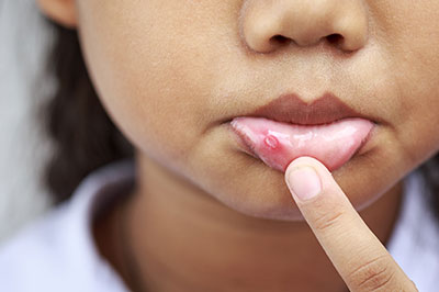 The image shows a close-up of a person s face with a focus on their lips, which appear to be irritated or inflamed, possibly due to an allergy or skin condition.