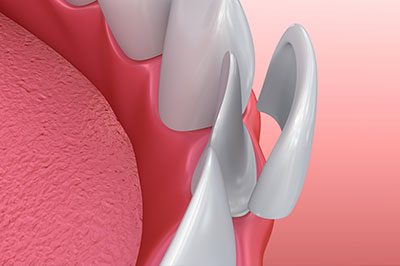The image displays a 3D rendering of a dental implant fixture with a pink gum tissue background, showing the implant s design and how it integrates into the mouth.