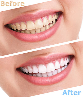 The image shows a before-and-after comparison of teeth whitening, with two different smiles side by side, one representing natural teeth color and the other showing the result after teeth whitening treatment.
